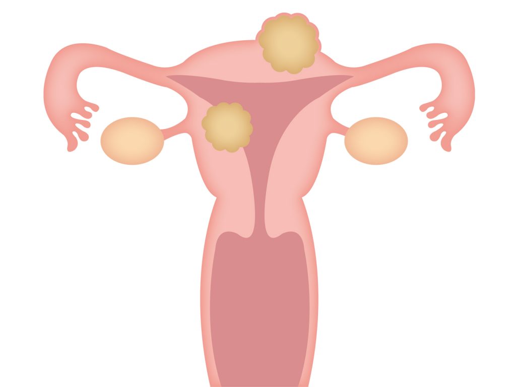 子宮筋腫のイメージ