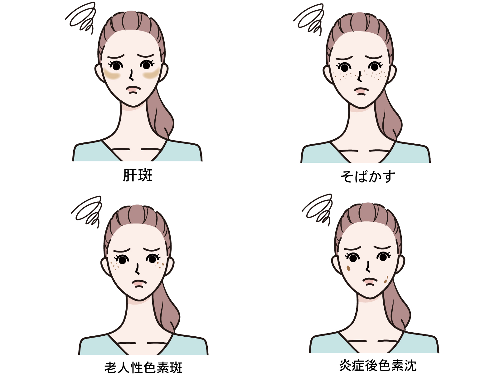 シミの種類のイメージ